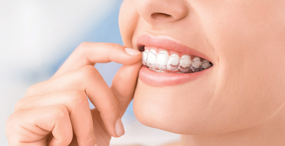 Invisalign® in Edmonton - Removable Clear Braces - Groove Dental